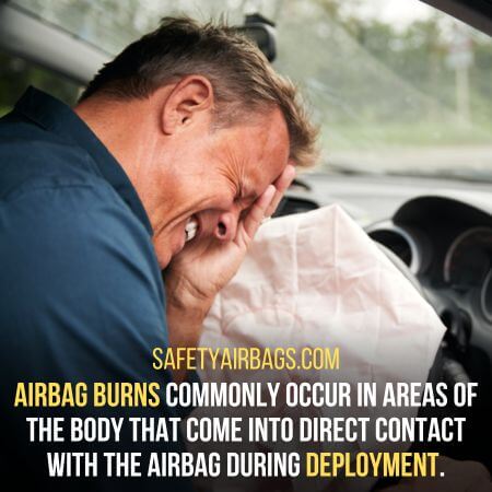 Airbag burns 