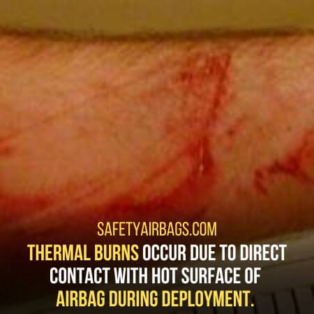 Thermal burns - AIRBAG BURNS